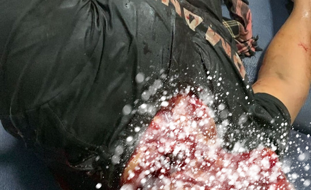 Leher Hampir putus Di Tebas Saat pergantian Malam Tahun Baru Leher Hampir putus Di Tebas Saat pergantian Malam Tahun Baru
